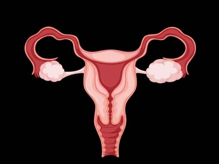 Ovarian Fibroma – Is It an Ovarian Cancer?