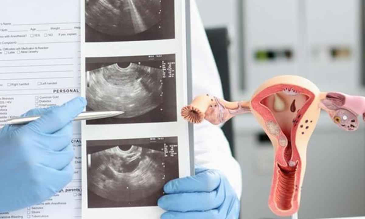 Can Uterine Polyps Go Away on Their Own?