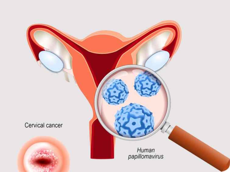 CERVICAL Cancer – Causes, Symptoms, Risks & Screening