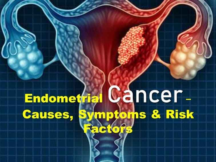 Endometrial Cancer Causes, Symptoms, Diagnosis and Treatment