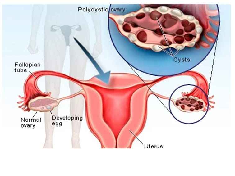How to Prevent PCOS | Dr. Rajeshwari Explains