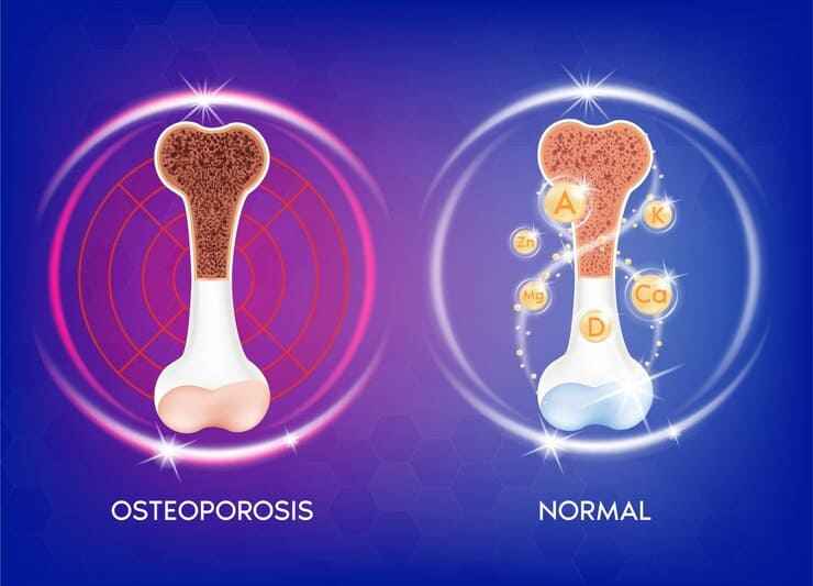 Postmenopausal Osteoporosis: Symptoms, Screening, and Treatment