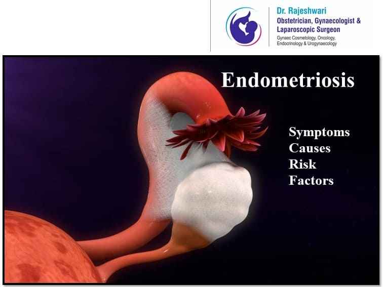 Endometriosis – Causes, Risk Factors and Symptoms