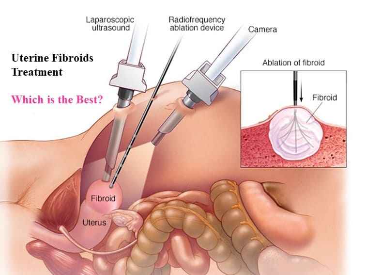 Uterine Fibroids Treatment – Which is the Best?