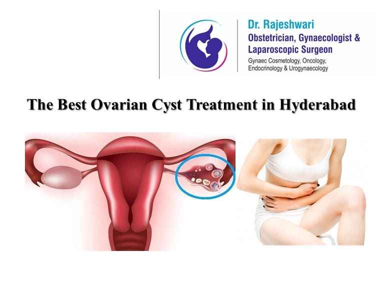 Ovarian Cyst Treatment – Which is the Best | Dr Rajeshwari Reddy