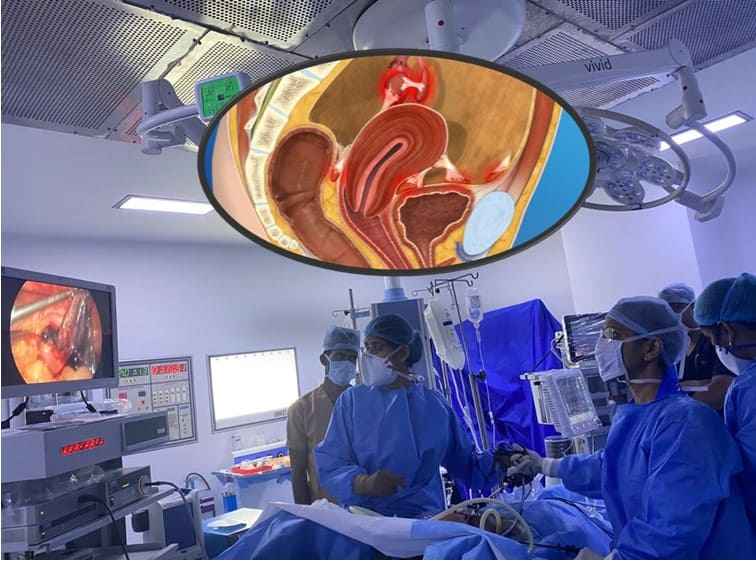 Endometriosis Treatment in Hyderabad – Is Laparoscopy the Best?