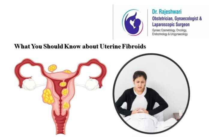What You Should Know about Uterine Fibroids?