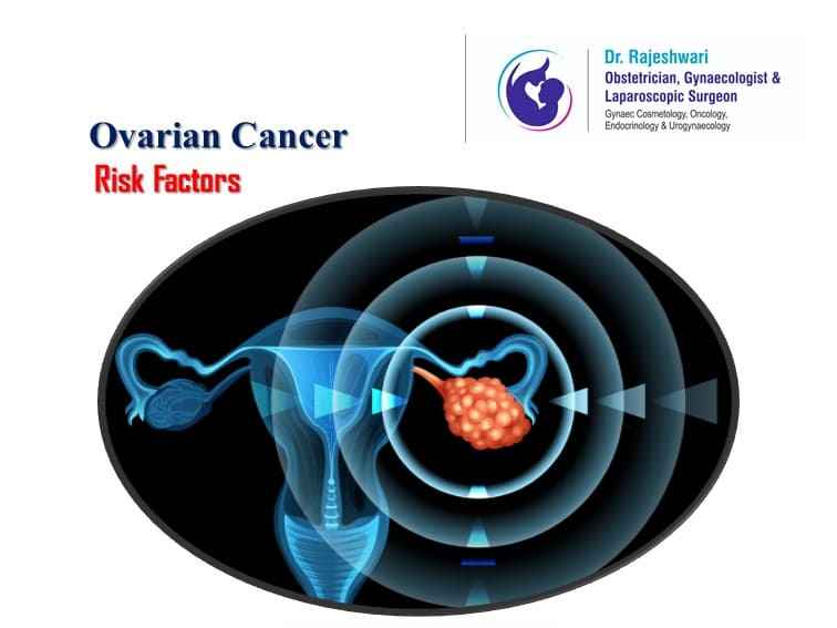 Ovarian Cancer (Tumour) – What is Your Personal Risk?