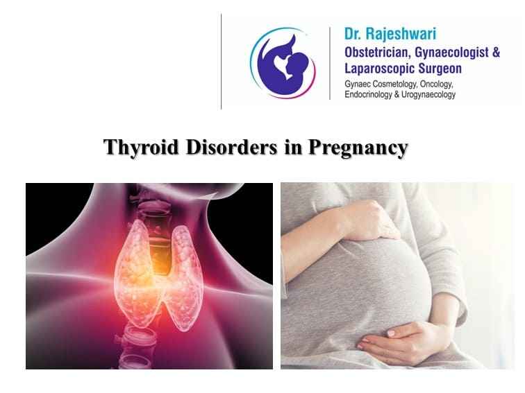 Thyroid Disorders in Pregnancy